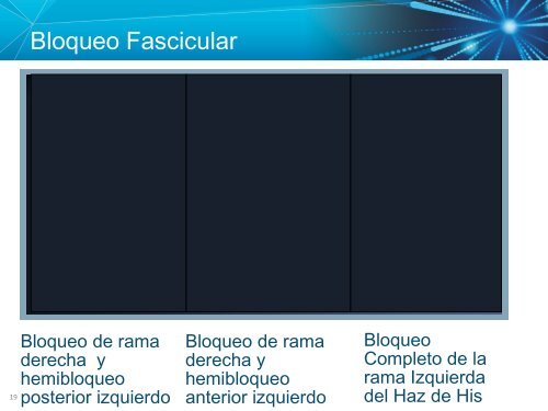 Bradiarritmias e Indicaciones de Marcapasos