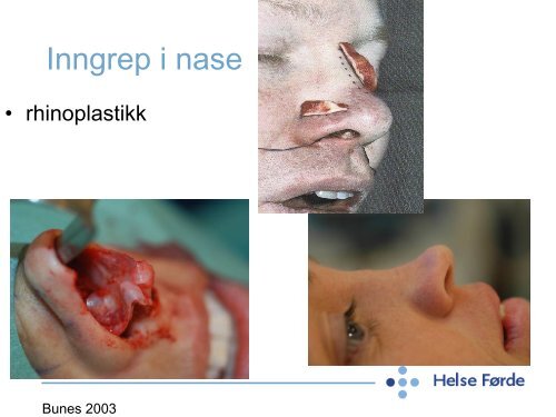 Dagkirurgi i ØNH faget - Helse Førde