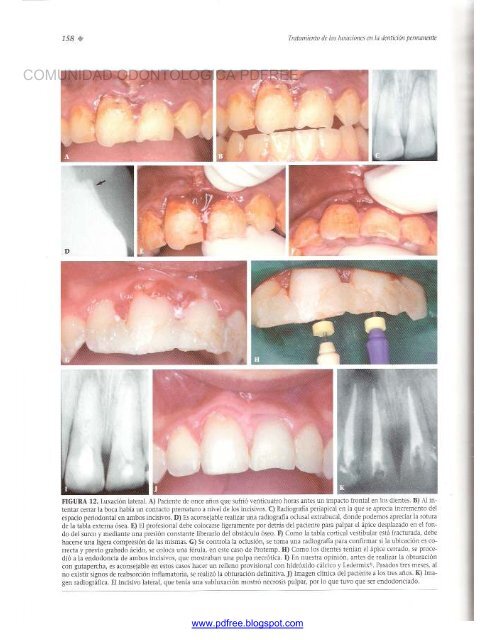 Traumatologia Oral en Odontopediatria: Diagnostico y tratamiento integral