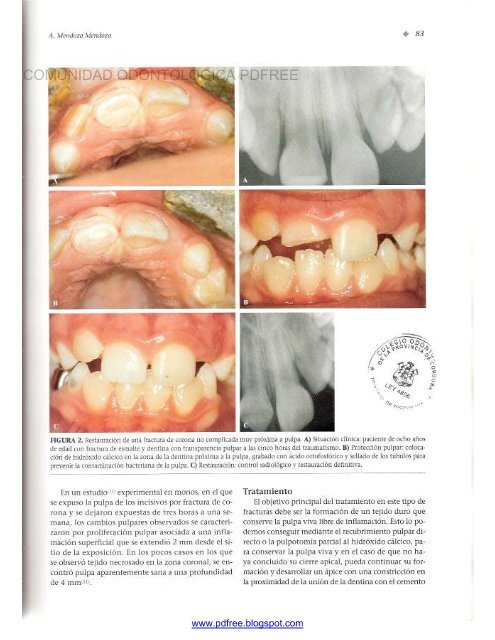 Traumatologia Oral en Odontopediatria: Diagnostico y tratamiento integral