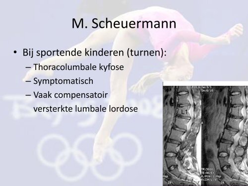 Rugklachten bij turnen
