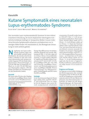 Kutane Symptomatik eines neonatalen Lupus-erythematodes ...