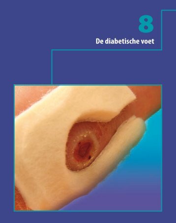 De diabetische voet - Acco