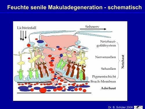 Epidemiologie der altersbedingten Makuladegeneration (AMD)