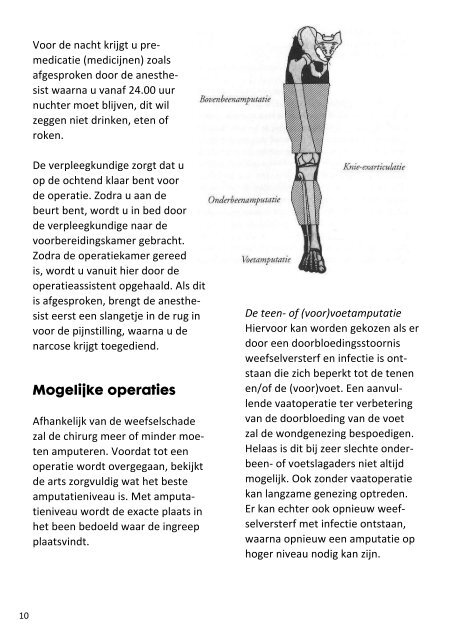 Amputatie van voet, onder- of bovenbeen - Catharina Ziekenhuis