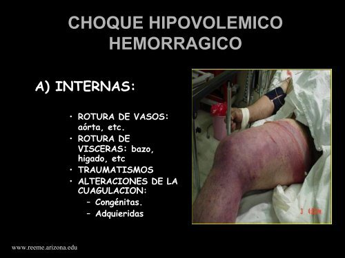 Choque Hipovolemico