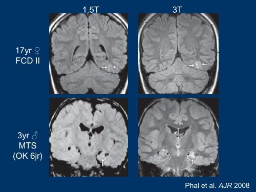 EpilepsiePlus, oorzaak structureel of niet - Epilepsie Vereniging ...