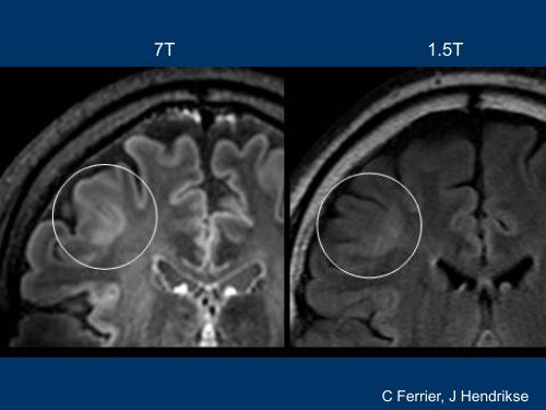 EpilepsiePlus, oorzaak structureel of niet - Epilepsie Vereniging ...