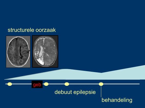 EpilepsiePlus, oorzaak structureel of niet - Epilepsie Vereniging ...