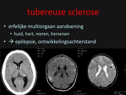 epilepsie syndromen diagnostiek en behandeling