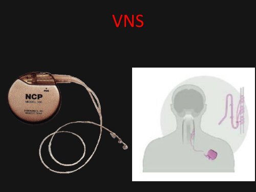 epilepsie syndromen diagnostiek en behandeling