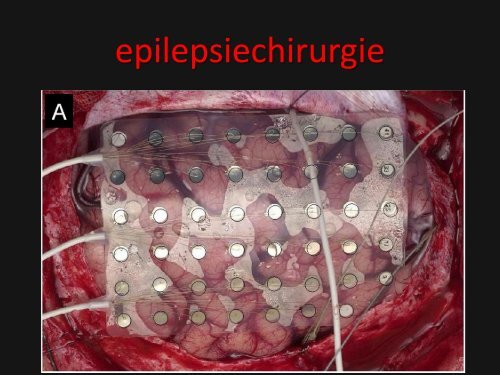 epilepsie syndromen diagnostiek en behandeling