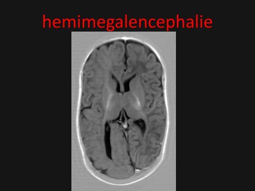 epilepsie syndromen diagnostiek en behandeling