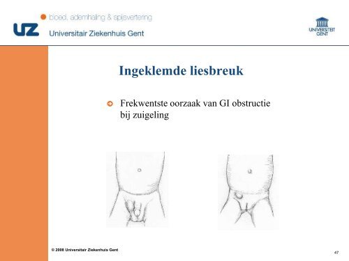 Pediatrische abdominale urgenties - Surgery.ugent.be