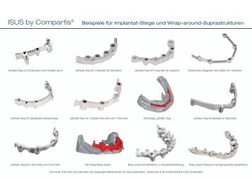 Beispiele für Implantat-Stege und Wrap-around ... - DeguDent GmbH