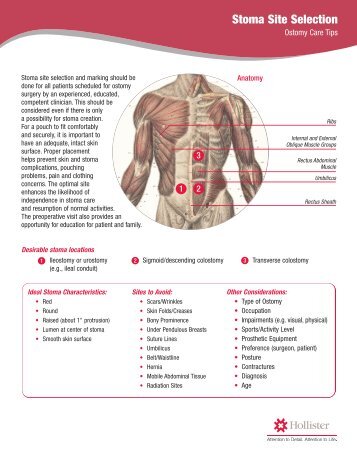 Stoma Site Selection - Hollister Incorporated