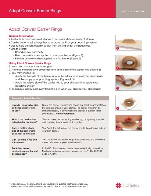 Adapt Convex Barrier Rings - Hollister Incorporated