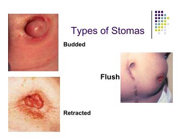 Types of Stomas