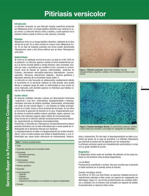 pitiriasis versicolor en genitales