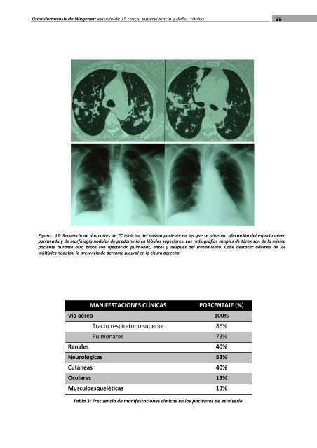 Granulomatosis de Wegener - Recercat