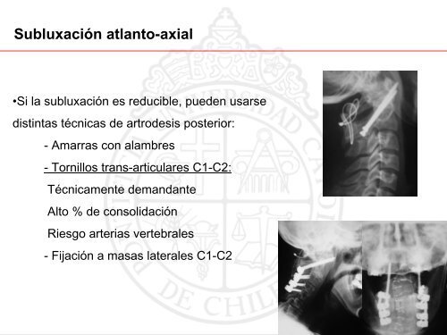 Artritis Reumatoide cervical. Tratamiento quirúrgico