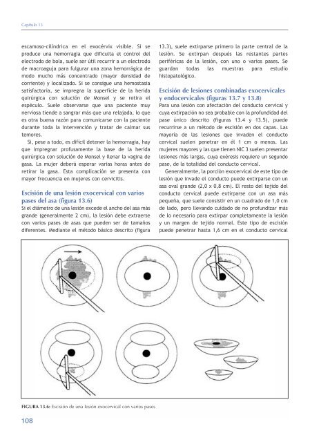 La colposcopia y el tratamiento de la neoplasia intraepitelial cervical: