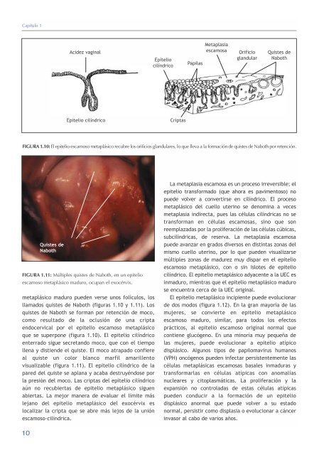 La colposcopia y el tratamiento de la neoplasia intraepitelial cervical: