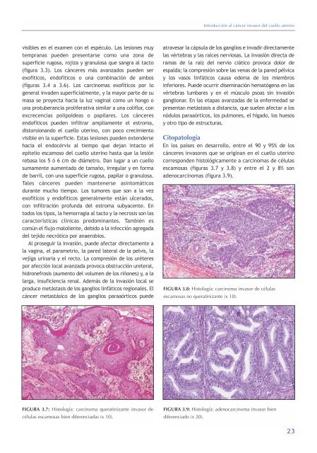 La colposcopia y el tratamiento de la neoplasia intraepitelial cervical: