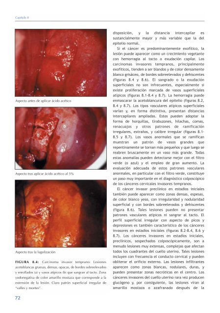 La colposcopia y el tratamiento de la neoplasia intraepitelial cervical: