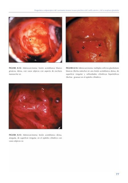 La colposcopia y el tratamiento de la neoplasia intraepitelial cervical: