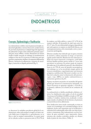 ENDOMETRIOSIS - Univadis