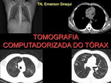 TOMOGRAFIA COMPUTADORIZADA DO TÓRAX - Comunidades