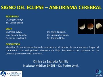 signo del eclipse – aneurisma cerebral - Congreso SORDIC