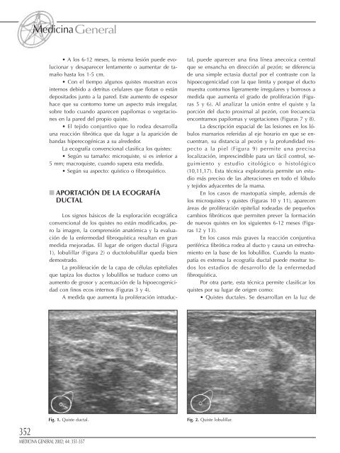 351 Mastopatía fibroquística: Aportación de la ecografía ductal