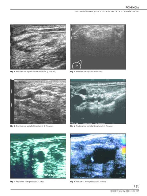 351 Mastopatía fibroquística: Aportación de la ecografía ductal