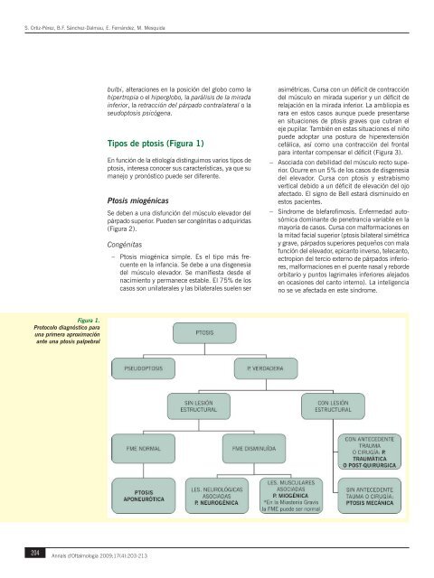 Ptosis palpebral - Nexus Médica