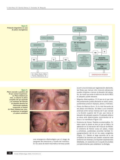 Ptosis palpebral - Nexus Médica