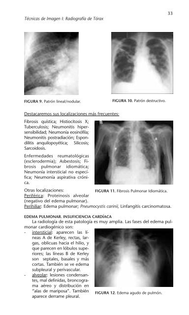 PATOLOGÍA RESPIRATORIA - Neumomadrid