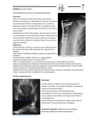 Fractura caso 3: Pseudoartrosis subcapital de húmero con rigidez