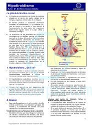 Hipotiroidismo (funcionamiento bajo del tiroides) - Endocorpas.com