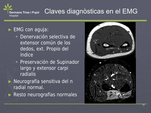 NEUROPATIA POR ATRAPAMIENTO