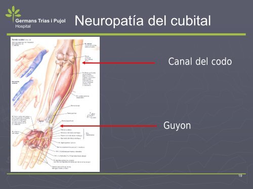 NEUROPATIA POR ATRAPAMIENTO