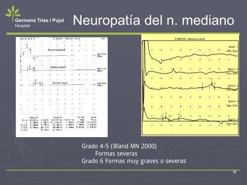 NEUROPATIA POR ATRAPAMIENTO