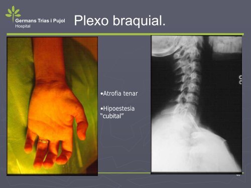 NEUROPATIA POR ATRAPAMIENTO