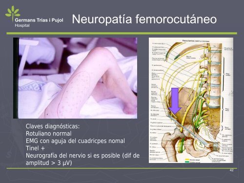 NEUROPATIA POR ATRAPAMIENTO