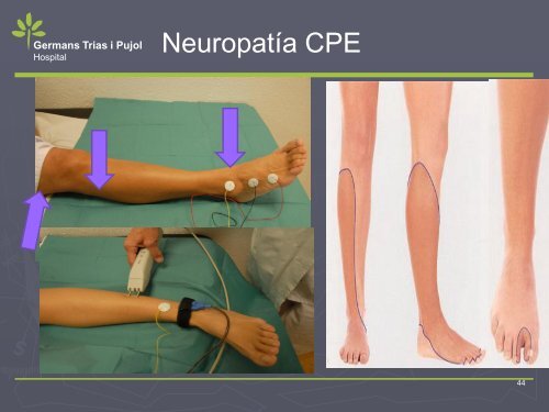 NEUROPATIA POR ATRAPAMIENTO