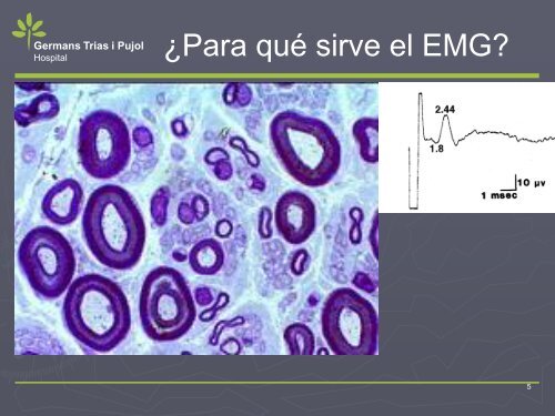 NEUROPATIA POR ATRAPAMIENTO