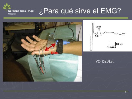 NEUROPATIA POR ATRAPAMIENTO