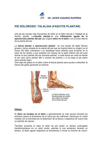 Fascitis Plantar (Talalgia) - docvadis