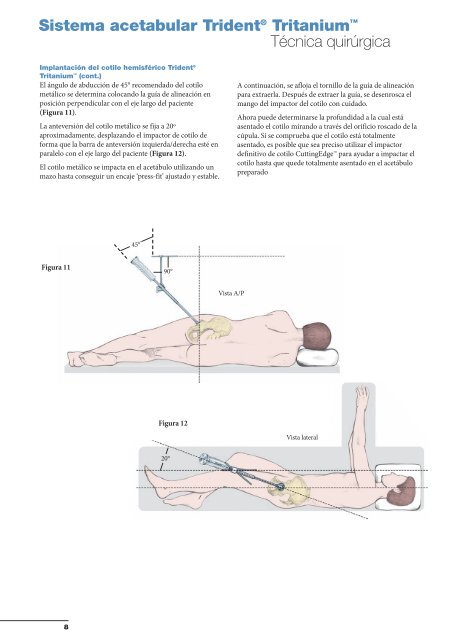 Sistema acetabular Trident® Tritanium™ - quirofano de Trauma